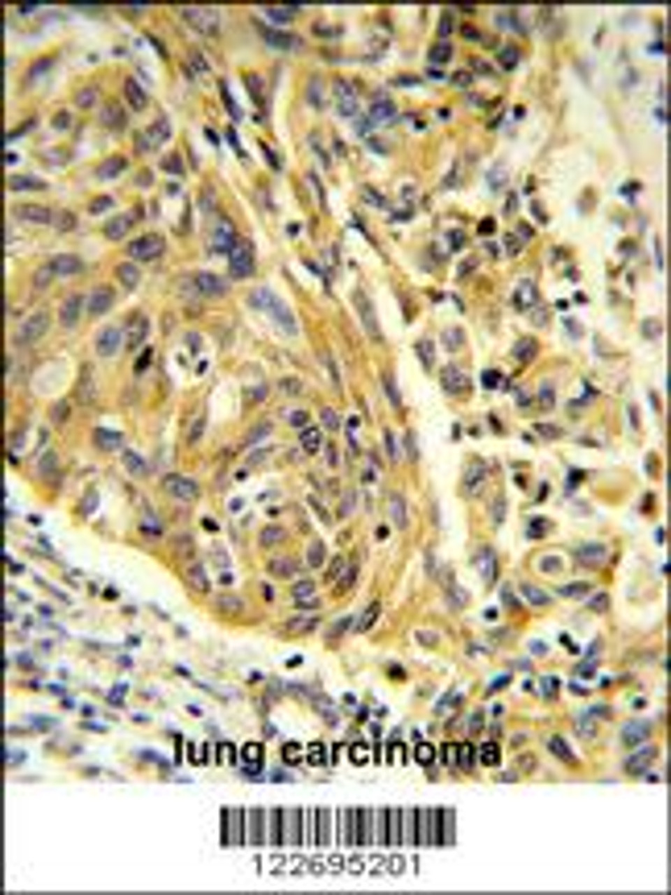 Formalin-fixed and paraffin-embedded human lung carcinoma reacted with CLTA Antibody, which was peroxidase-conjugated to the secondary antibody, followed by DAB staining.