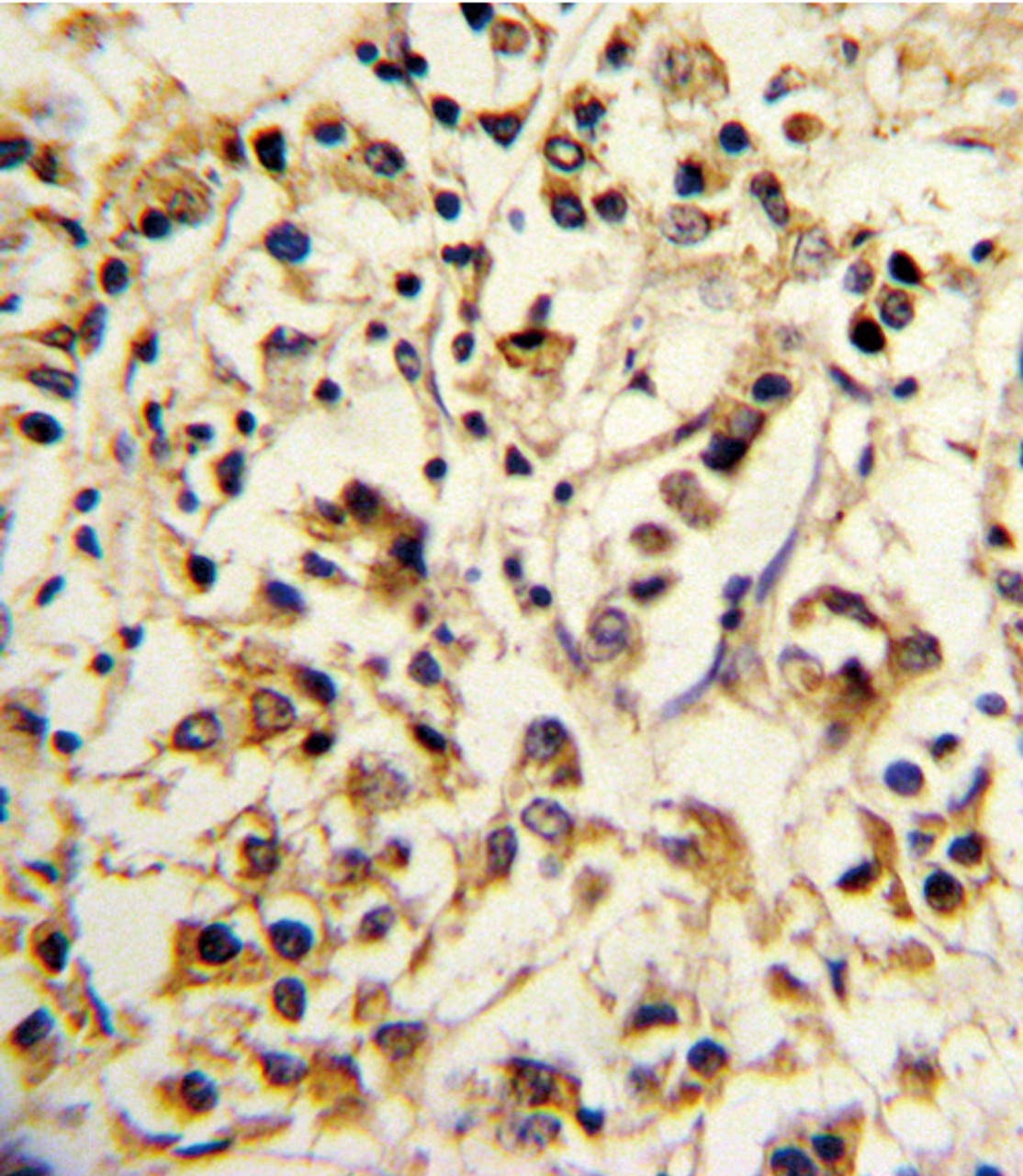 Formalin-fixed and paraffin-embedded human breast carcinoma reacted with KIR2DL4 Antibody, which was peroxidase-conjugated to the secondary antibody, followed by DAB staining.