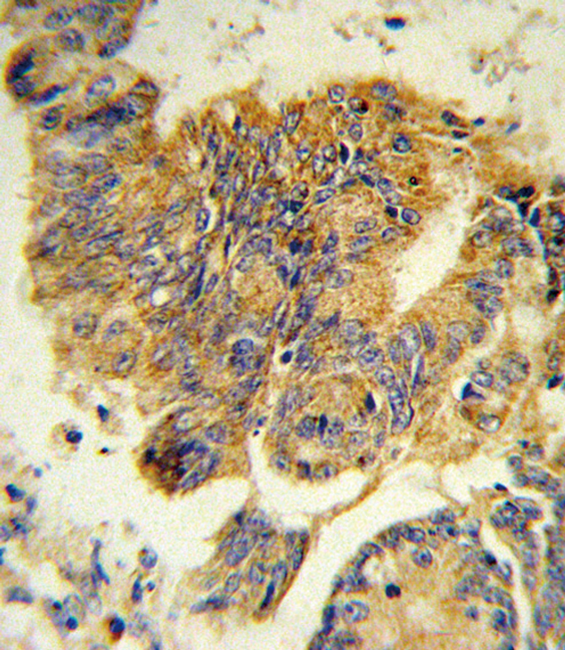 Formalin-fixed and paraffin-embedded human colon carcinoma reacted with CSF3R Antibody, which was peroxidase-conjugated to the secondary antibody, followed by DAB staining.