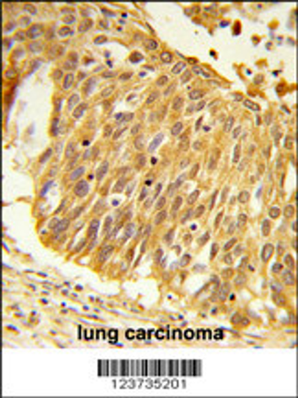 Formalin-fixed and paraffin-embedded human lung carcinoma reacted with EEFSEC Antibody, which was peroxidase-conjugated to the secondary antibody, followed by DAB staining.