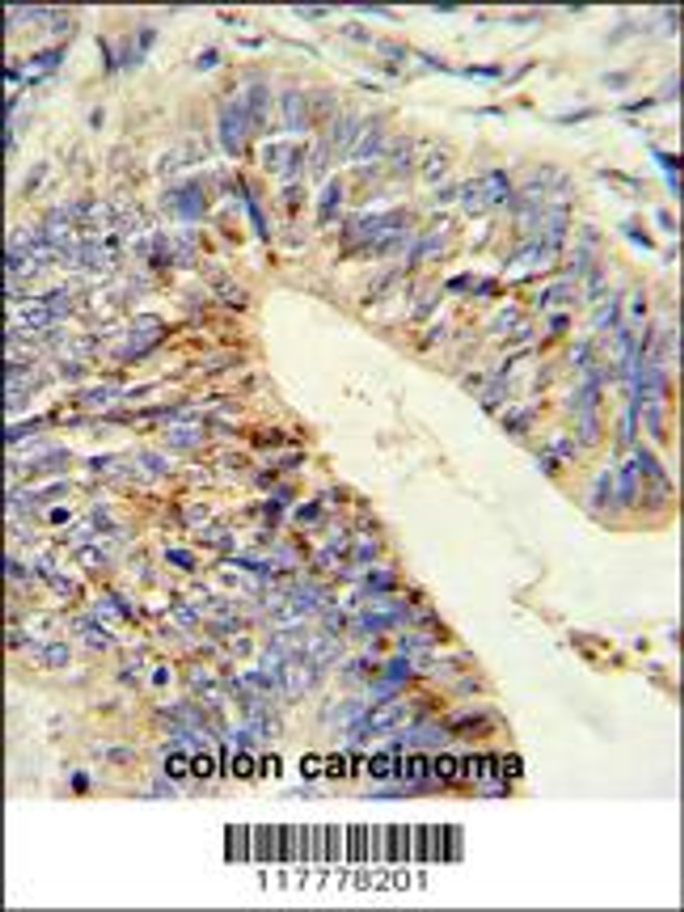 Formalin-fixed and paraffin-embedded human colon carcinoma reacted with ADAMDEC1 Antibody (N-term) , which was peroxidase-conjugated to the secondary antibody, followed by DAB staining.