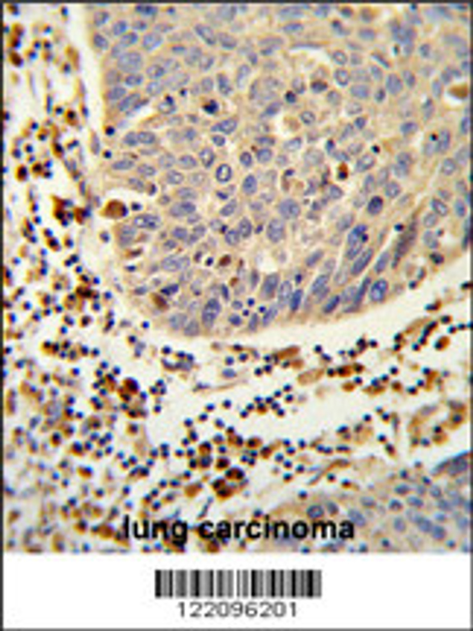 Formalin-fixed and paraffin-embedded human lung carcinoma reacted with SH2D1B Antibody, which was peroxidase-conjugated to the secondary antibody, followed by DAB staining.