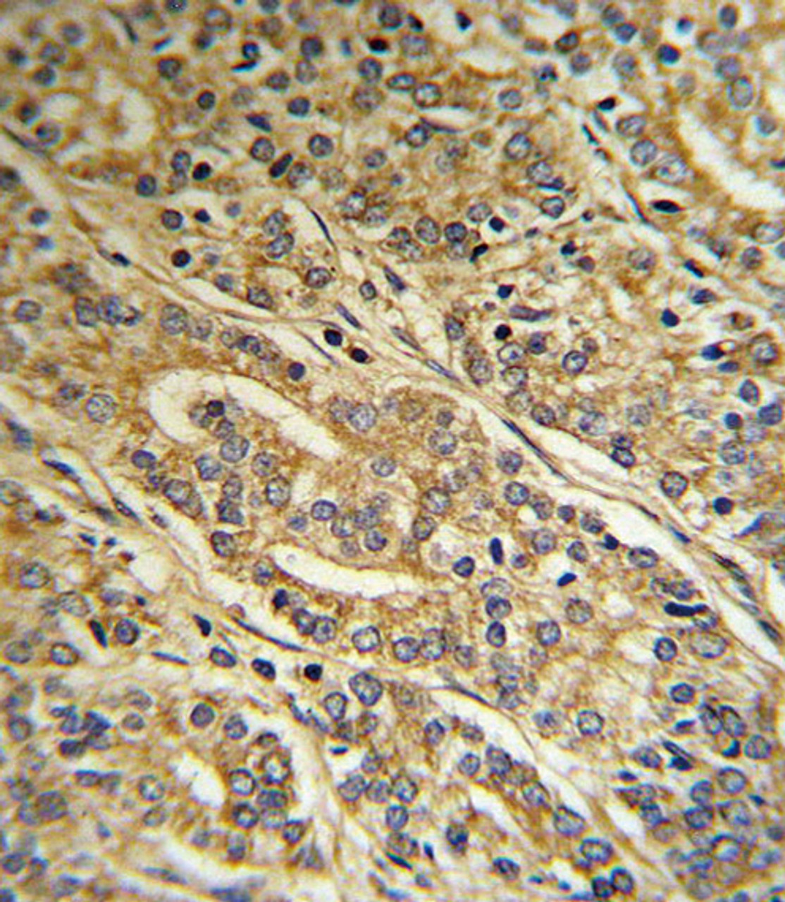 Formalin-fixed and paraffin-embedded human Prostate carcinoma reacted with ACOT8 Antibody, which was peroxidase-conjugated to the secondary antibody, followed by DAB staining.