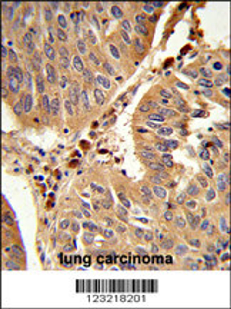 Formalin-fixed and paraffin-embedded human lung carcinoma reacted with PEX16 Antibody, which was peroxidase-conjugated to the secondary antibody, followed by DAB staining.