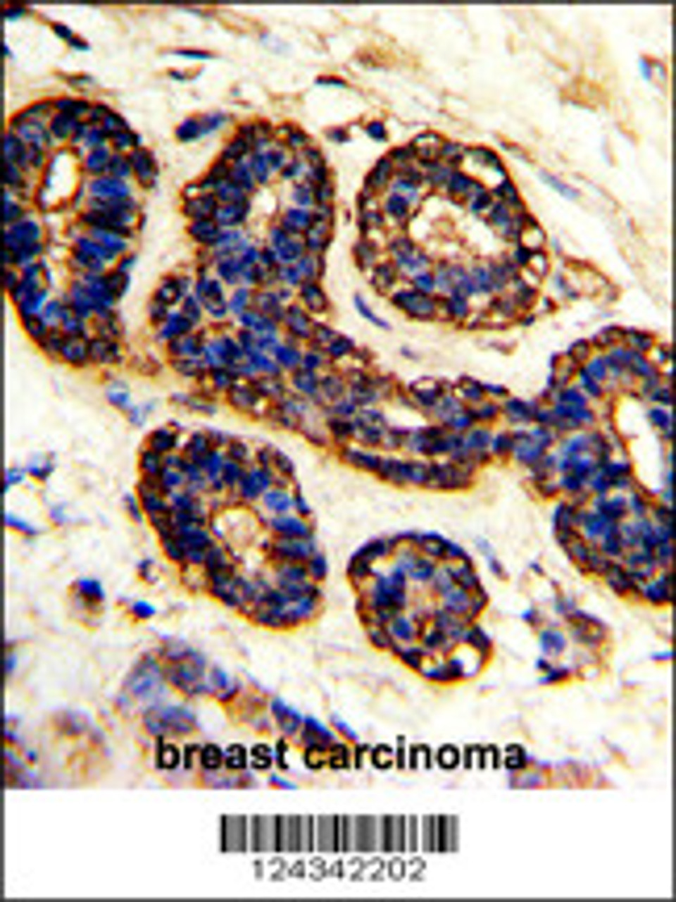 Formalin-fixed and paraffin-embedded human breast carcinoma with BEST2 Antibody, which was peroxidase-conjugated to the secondary antibody, followed by DAB staining.