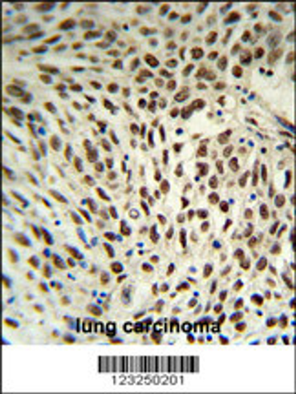 SNRPD3 Antibody IHC analysis in formalin fixed and paraffin embedded human lung carcinoma followed by peroxidase conjugation of the secondary antibody and DAB staining.