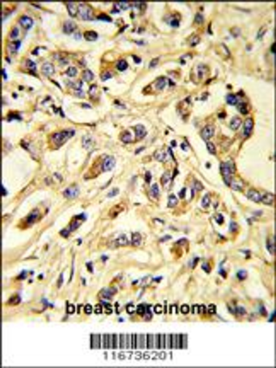 Formalin-fixed and paraffin-embedded human breast carcinoma reacted with VGFR1 Antibody, which was peroxidase-conjugated to the secondary antibody, followed by DAB staining.