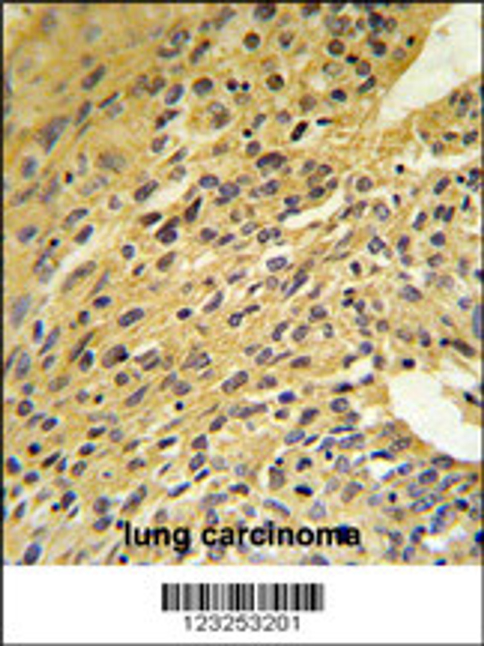 COQ5 Antibody IHC analysis in formalin fixed and paraffin embedded human lung carcinoma followed by peroxidase conjugation of the secondary antibody and DAB staining.