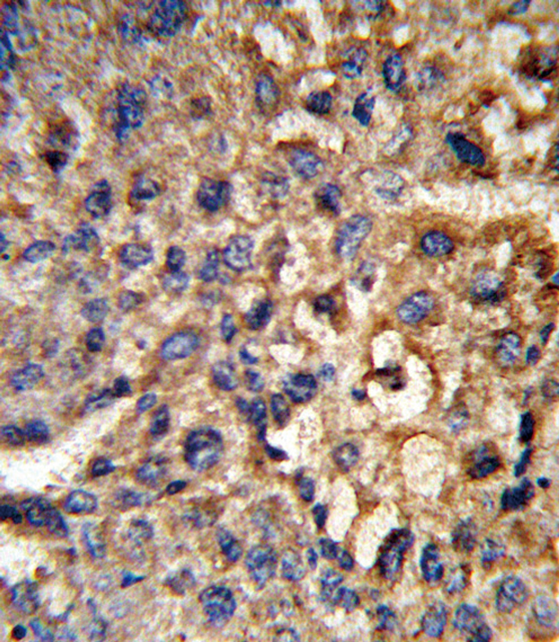 Formalin-fixed and paraffin-embedded human hepatocarcinoma reacted with HSD17B12 Antibody, which was peroxidase-conjugated to the secondary antibody, followed by DAB staining.