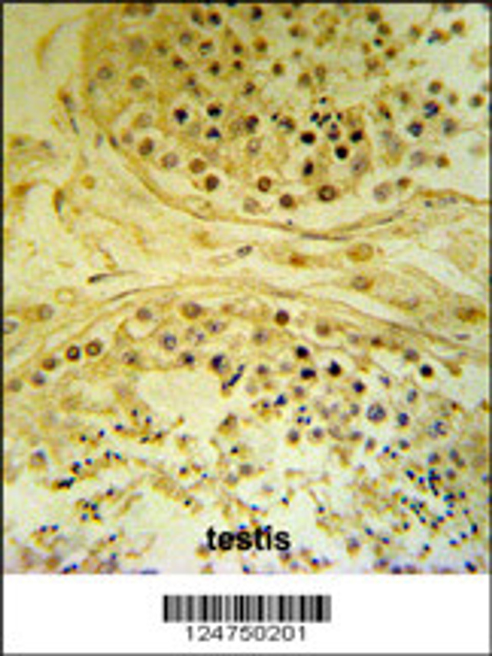 IMP4 Antibody IHC analysis in formalin fixed and paraffin embedded human testis carcinoma followed by peroxidase conjugation of the secondary antibody and DAB staining.