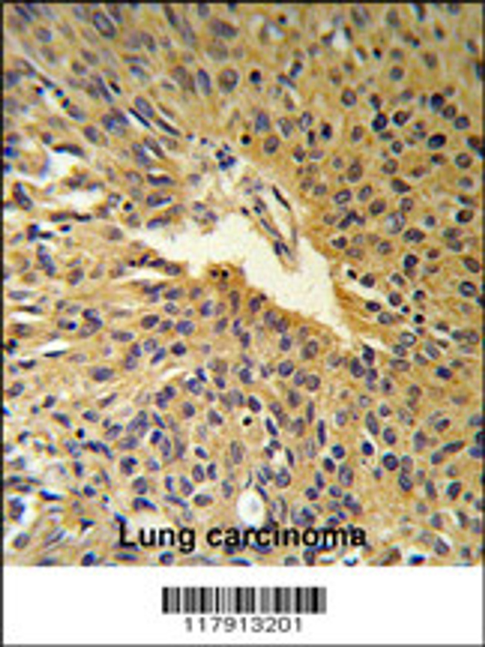 COG2 Antibody (RB17913) IHC analysis in formalin fixed and paraffin embedded human Lung carcinoma followed by peroxidase conjugation of the secondary antibody and DAB staining.