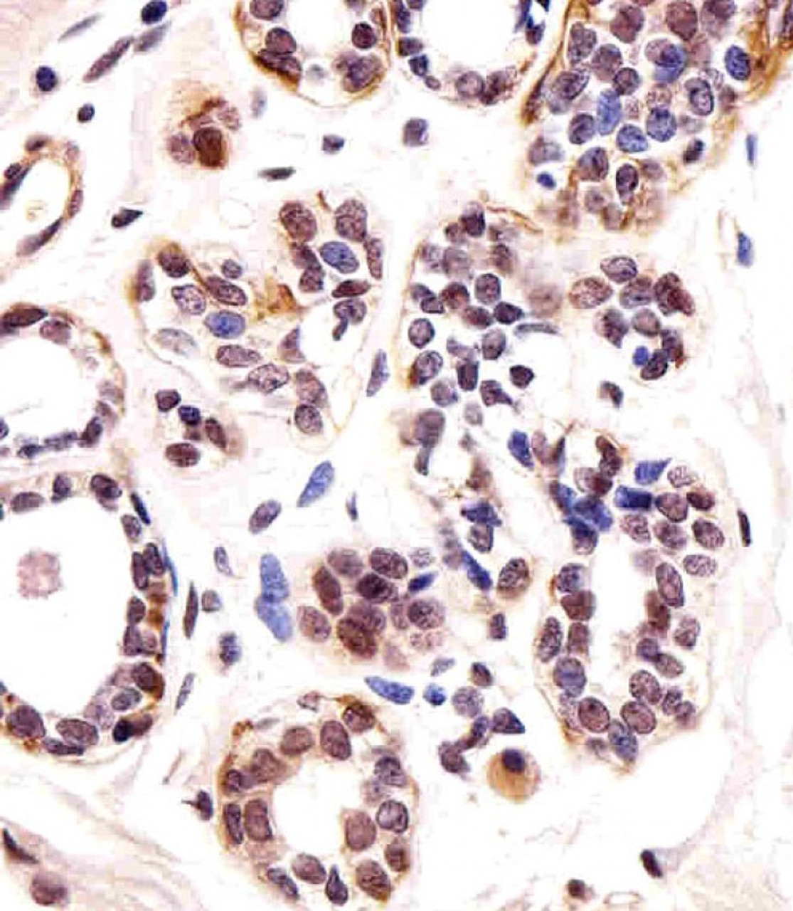 Immunohistochemical analysis of paraffin-embedded H. breast section using TBX1 Antibody . Antibody was diluted at 1:25 dilution. A undiluted biotinylated goat polyvalent antibody was used as the secondary, followed by DAB staining.