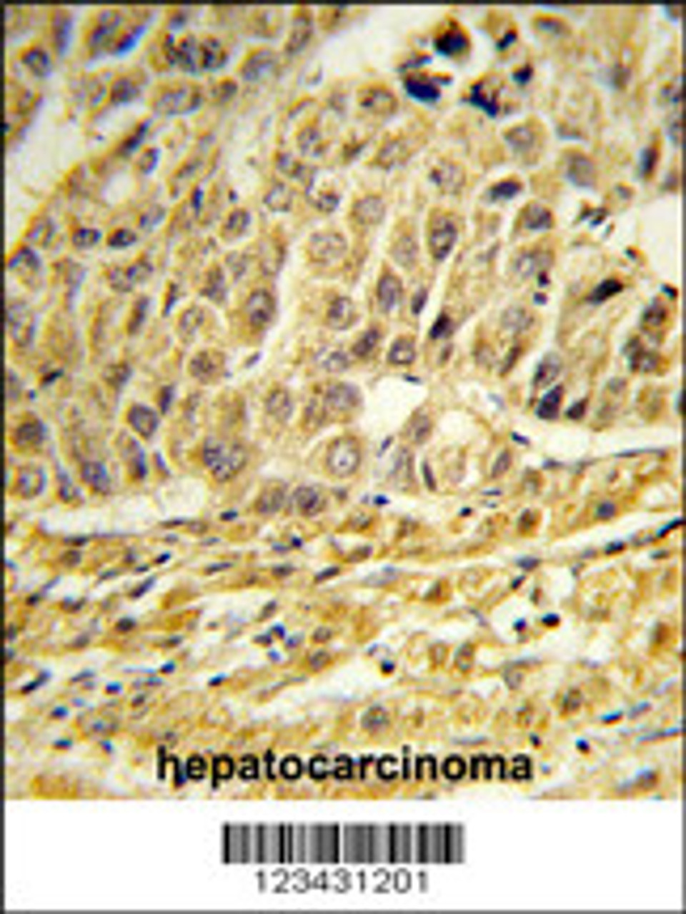Formalin-fixed and paraffin-embedded human hepatocarcinoma reacted with CCNB1IP1 Antibody, which was peroxidase-conjugated to the secondary antibody, followed by DAB staining.