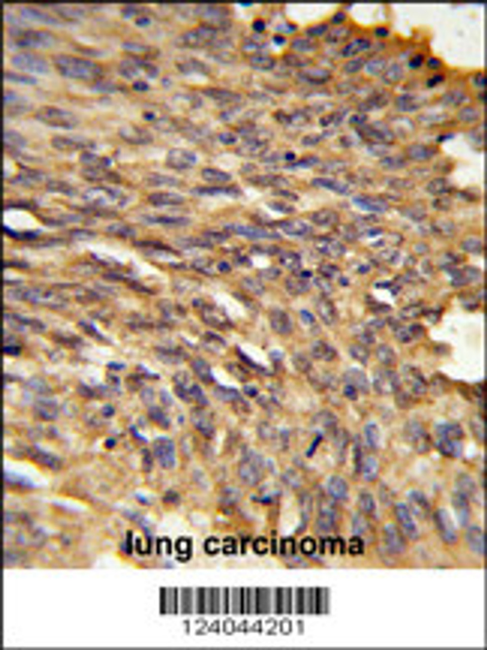 Formalin-fixed and paraffin-embedded human lung carcinoma reacted with HDLBP Antibody, which was peroxidase-conjugated to the secondary antibody, followed by DAB staining.