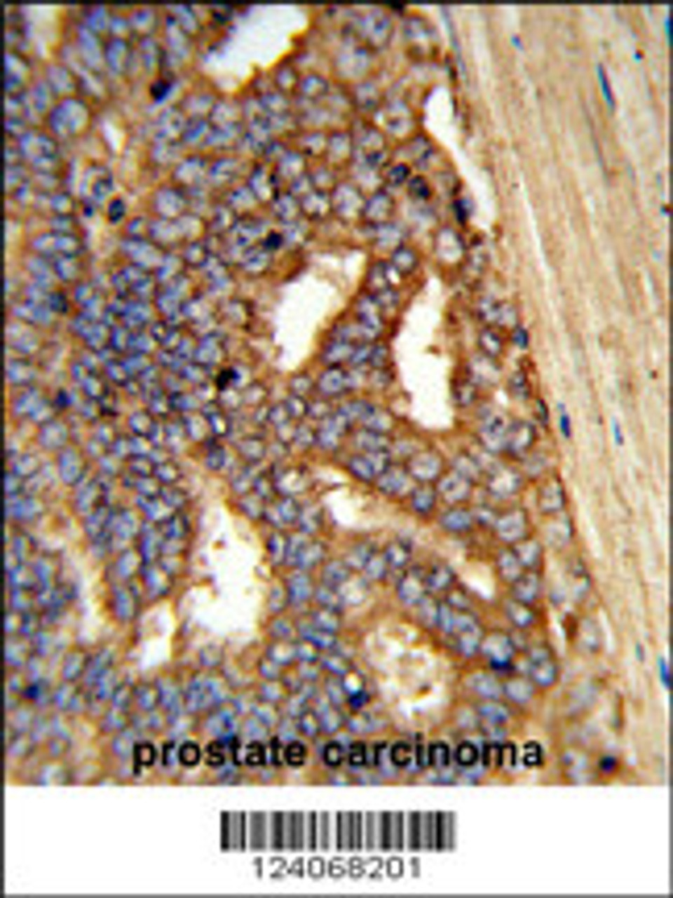 Formalin-fixed and paraffin-embedded human prostate carcinoma reacted with AMY1A Antibody, which was peroxidase-conjugated to the secondary antibody, followed by DAB staining.