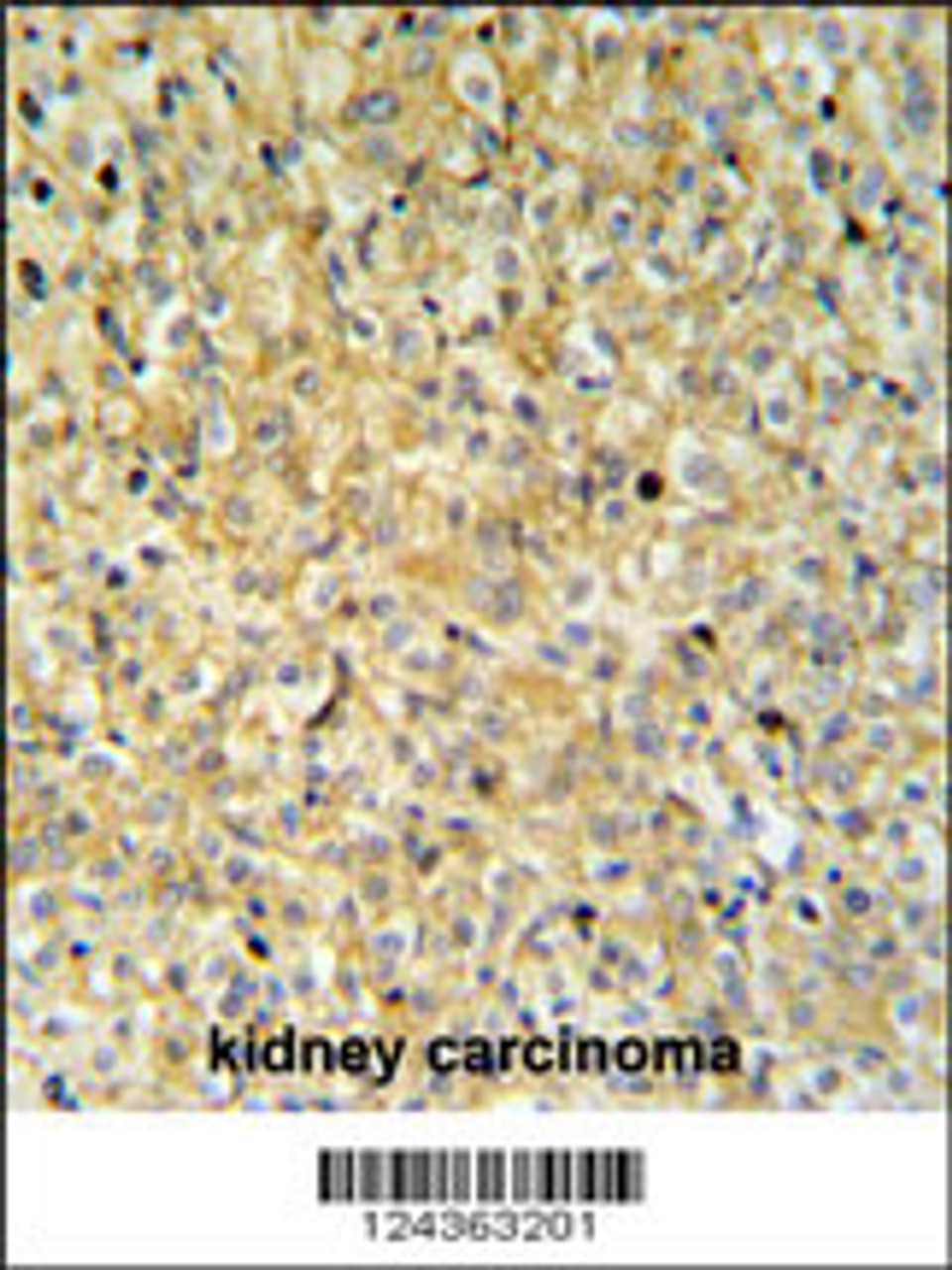 MAPK1IP1L Antibody IHC analysis in formalin fixed and paraffin embedded kidney carcinoma followed by peroxidase conjugation of the secondary antibody and DAB staining.