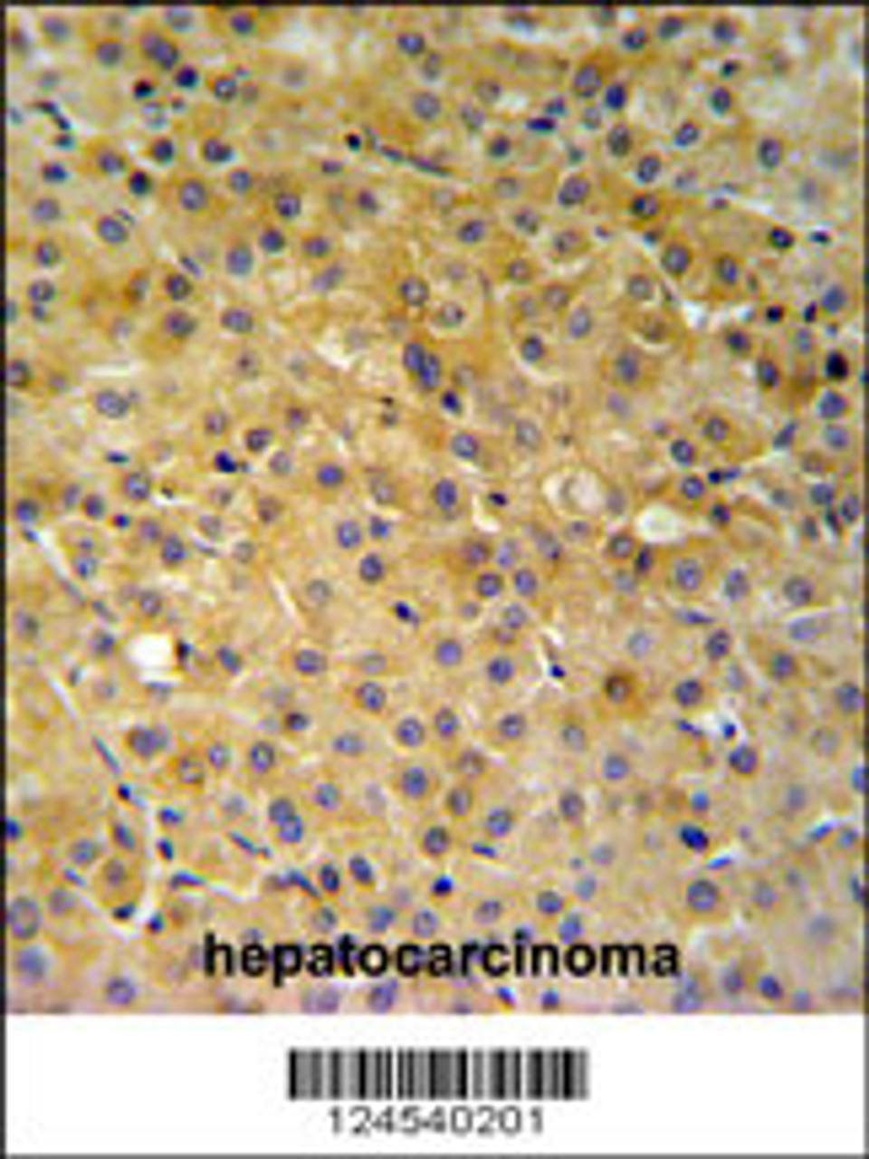 NDUFA10 Antibody IHC analysis in formalin fixed and paraffin embedded hepatocarcinoma followed by peroxidase conjugation of the secondary antibody and DAB staining.