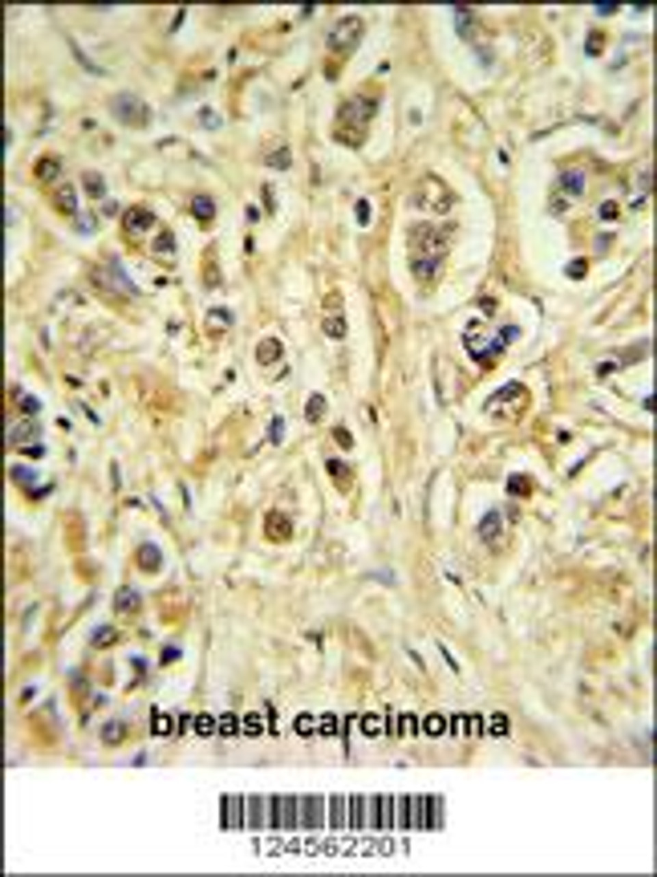 ZNF202 Antibody IHC analysis in formalin fixed and paraffin embedded breast carcinoma followed by peroxidase conjugation of the secondary antibody and DAB staining.