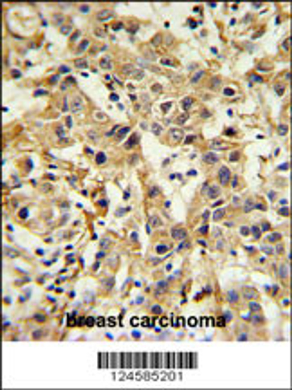 CA6 Antibody IHC analysis in formalin fixed and paraffin embedded breast carcinoma followed by peroxidase conjugation of the secondary antibody and DAB staining.