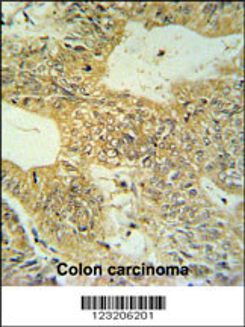 CLDN23 Antibody IHC analysis in formalin fixed and paraffin embedded colon carcinoma followed by peroxidase conjugation of the secondary antibody and DAB staining.