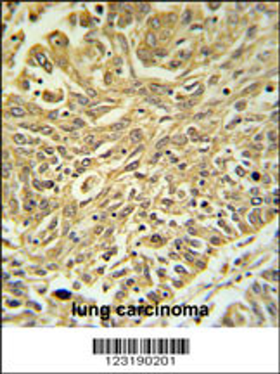 GSTK1 Antibody IHC analysis in formalin fixed and paraffin embedded lung carcinoma followed by peroxidase conjugation of the secondary antibody and DAB staining.