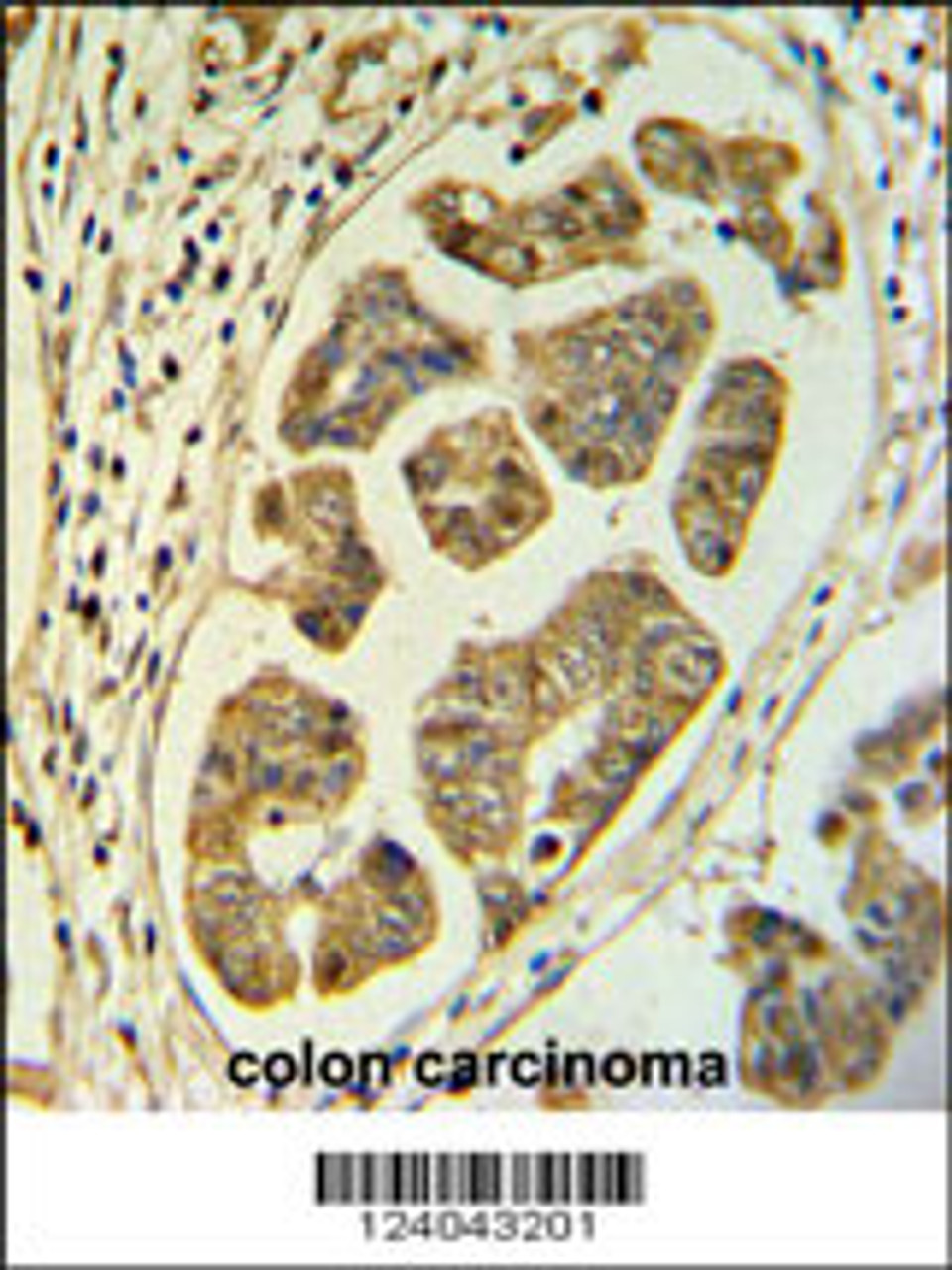 HCCS Antibody IHC analysis in formalin fixed and paraffin embedded colon carcinoma followed by peroxidase conjugation of the secondary antibody and DAB staining.