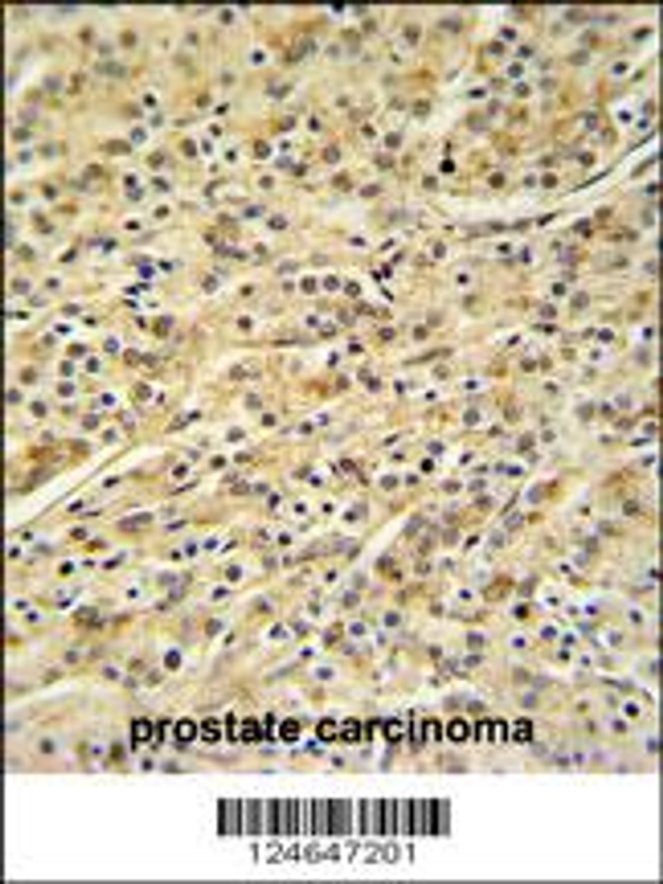 HOXA3 Antibody IHC analysis in formalin fixed and paraffin embedded prostate carcinoma followed by peroxidase conjugation of the secondary antibody and DAB staining.