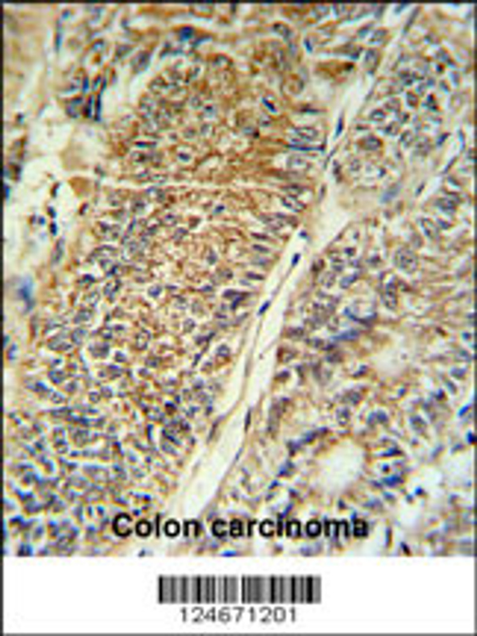 PYCR1 Antibody IHC analysis in formalin fixed and paraffin embedded colon carcinoma followed by peroxidase conjugation of the secondary antibody and DAB staining.