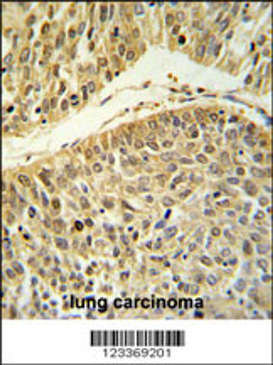 RERE Antibody IHC analysis in formalin fixed and paraffin embedded lung carcinoma followed by peroxidase conjugation of the secondary antibody and DAB staining.