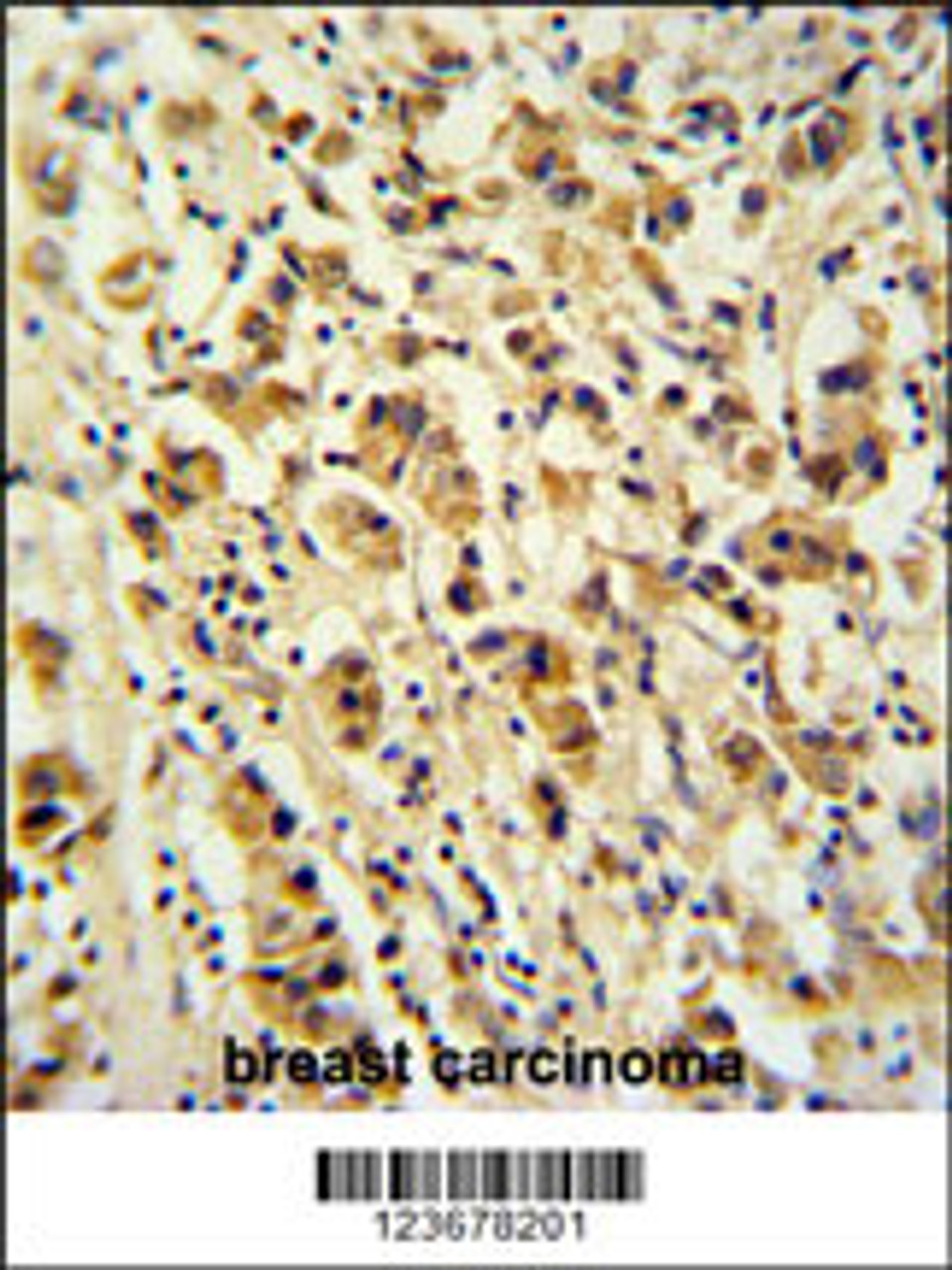 DDX49 Antibody immunohistochemistry analysis in formalin fixed and paraffin embedded human breast carcinoma followed by peroxidase conjugation of the secondary antibody and DAB staining.