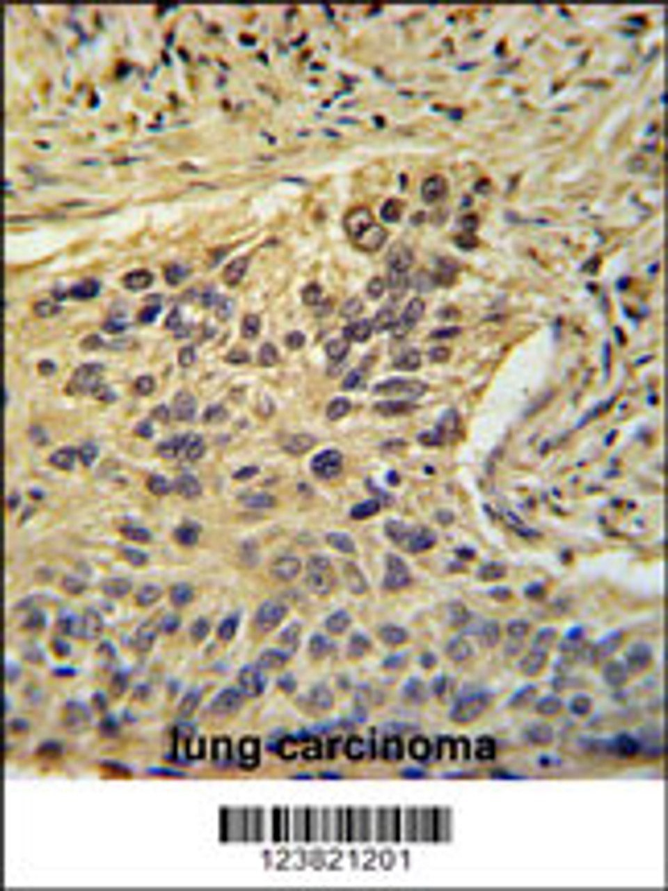 TAF2 Antibody immunohistochemistry analysis in formalin fixed and paraffin embedded human lung carcinoma followed by peroxidase conjugation of the secondary antibody and DAB staining.