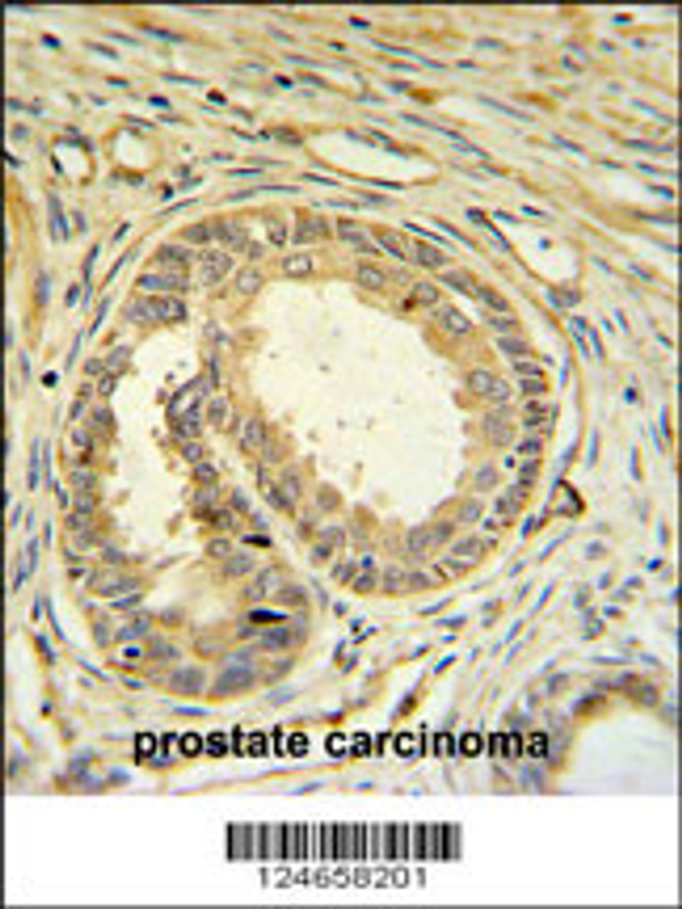 SPDYA Antibody IHC analysis in formalin fixed and paraffin embedded prostate carcinoma followed by peroxidase conjugation of the secondary antibody and DAB staining.