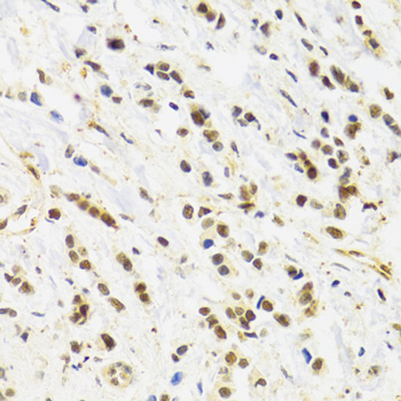 Immunohistochemistry of paraffin-embedded human breast cancer using RAD50 Antibody (13-069) at dilution of 1:100 (40x lens) .