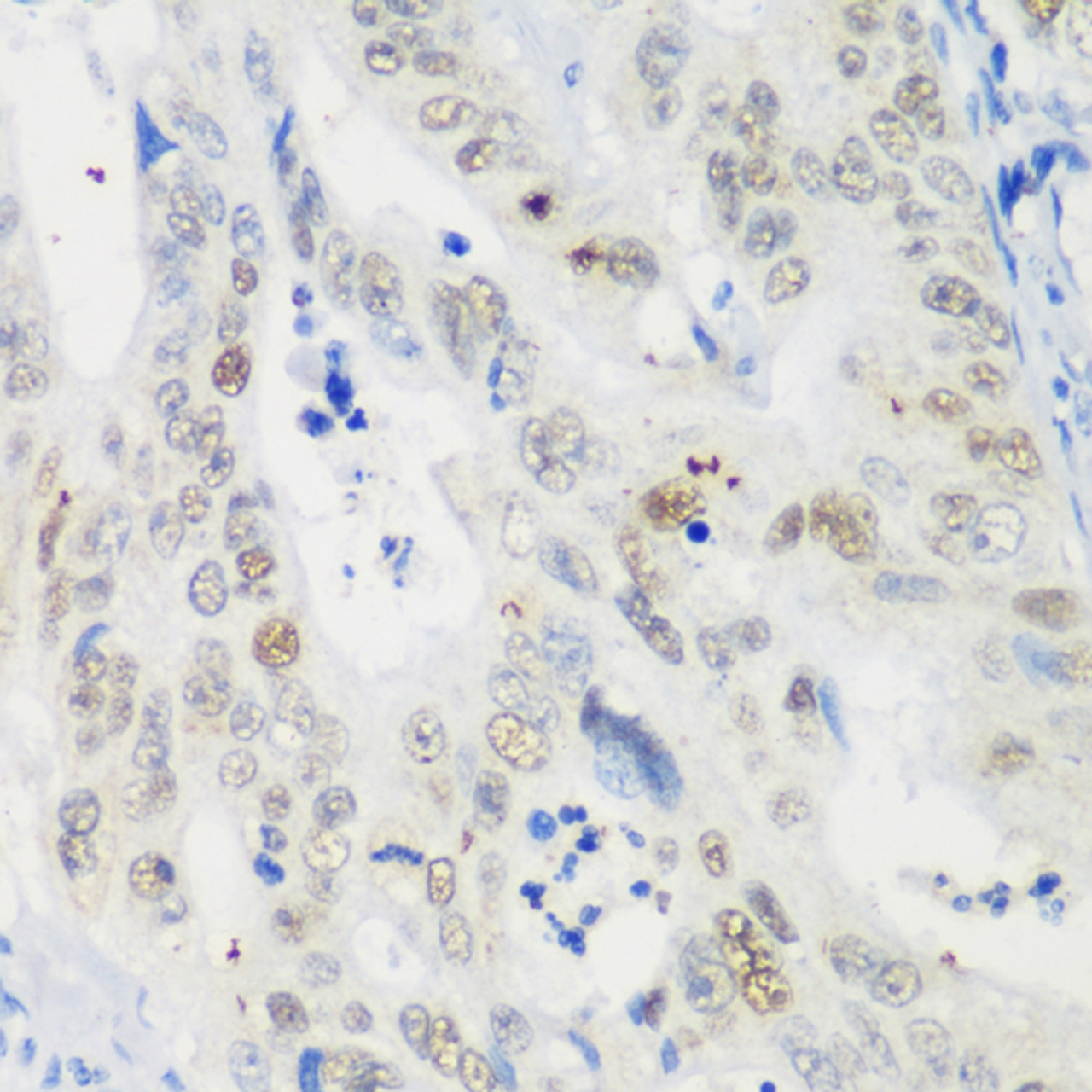 Immunohistochemistry of paraffin-embedded human colon carcinoma using p53 antibody (13-113) at dilution of 1:200 (40x lens) .