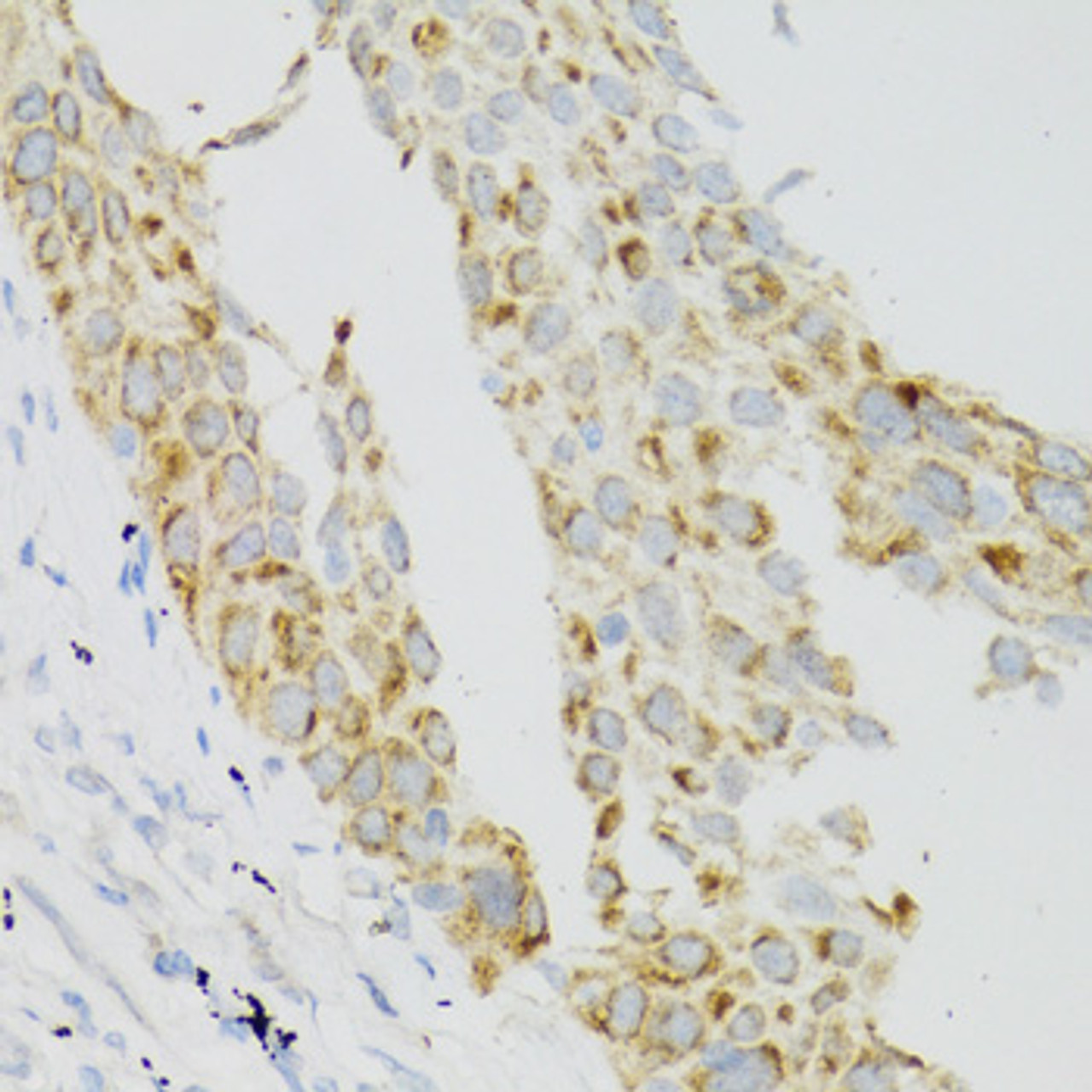 Immunohistochemistry of paraffin-embedded human lung cancer using TEK antibody (13-270) at dilution of 1:100 (40x lens) .