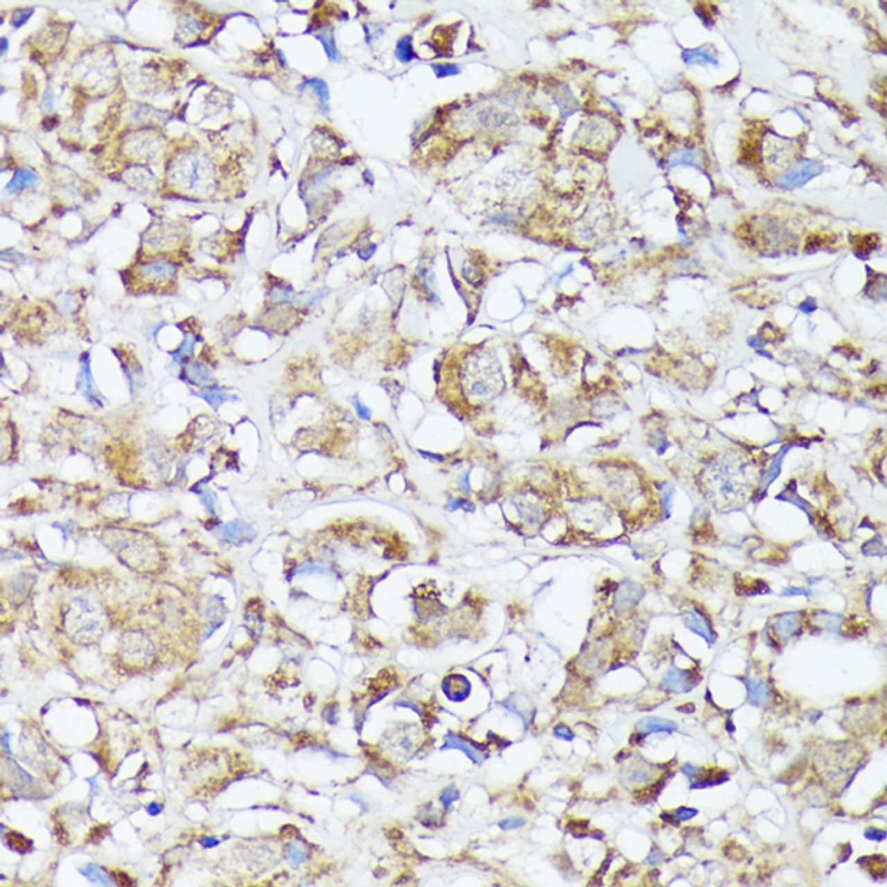 Immunohistochemistry of paraffin-embedded human mammary cancer using MTHFD2 antibody (13-620) at dilution of 1:100 (40x lens) .