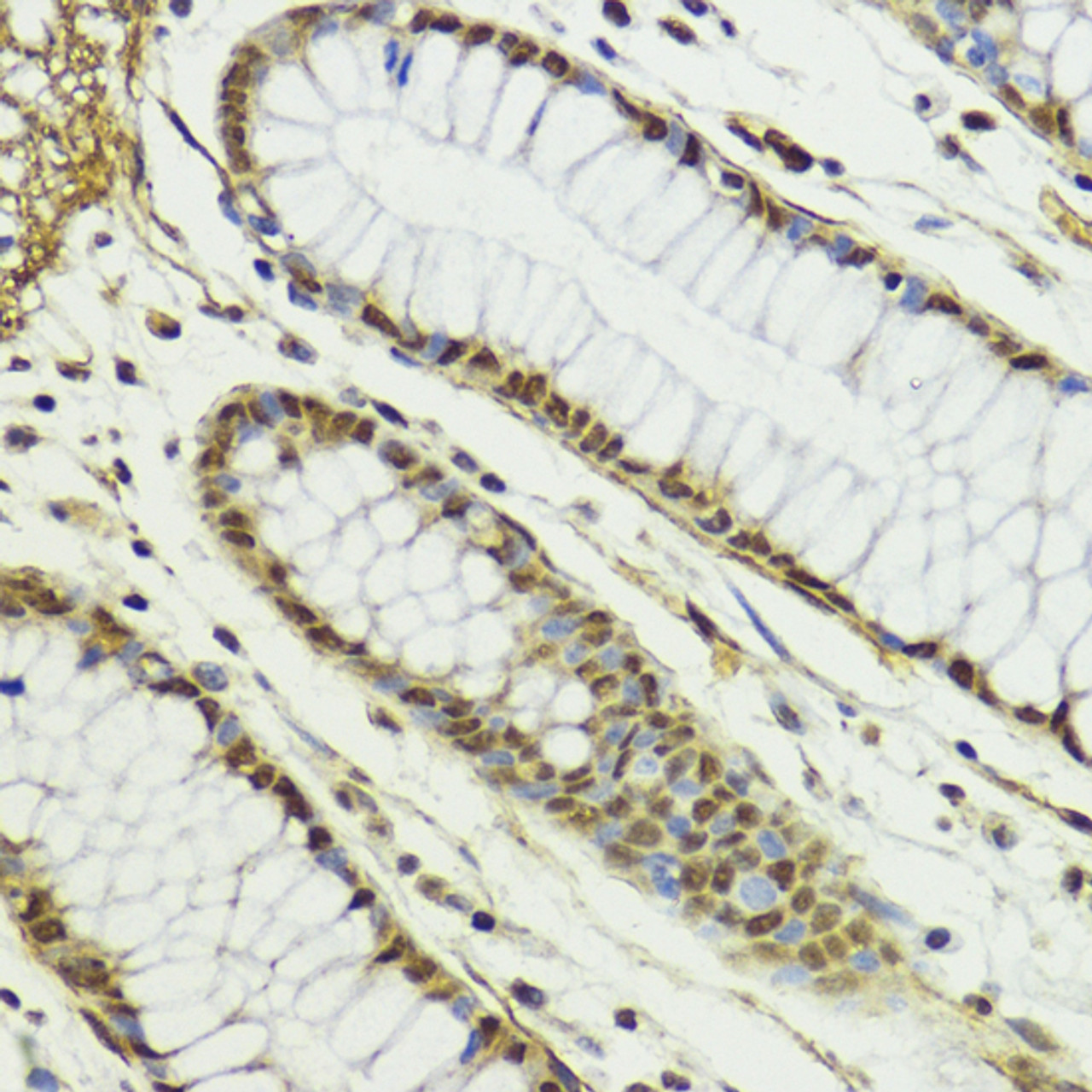 Immunohistochemistry of paraffin-embedded human colon using CTCF antibody (13-987) at dilution of 1:100 (40x lens) .