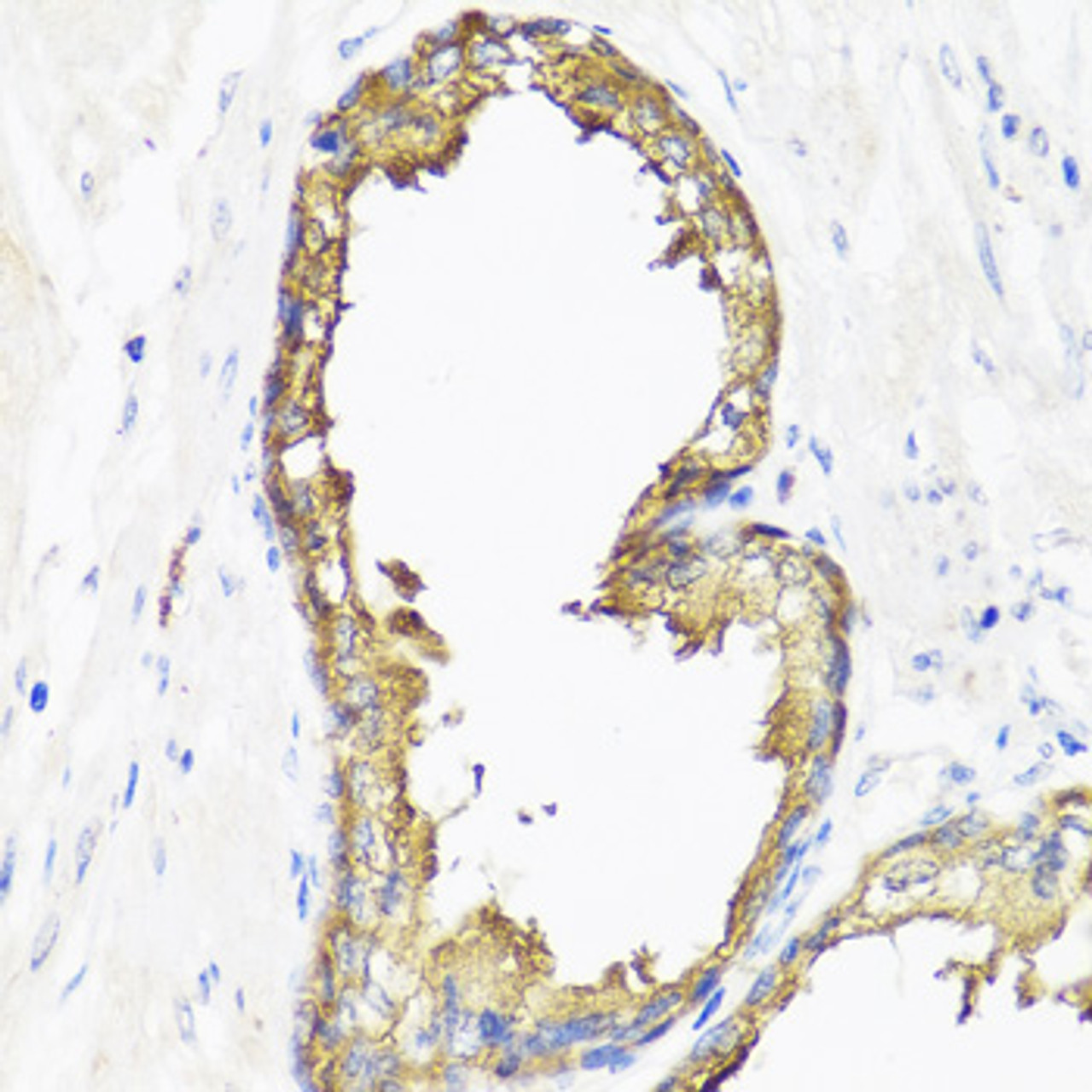 Immunohistochemistry of paraffin-embedded human prostate using SMAD2 antibody (14-036) at dilution of 1:100 (40x lens) .