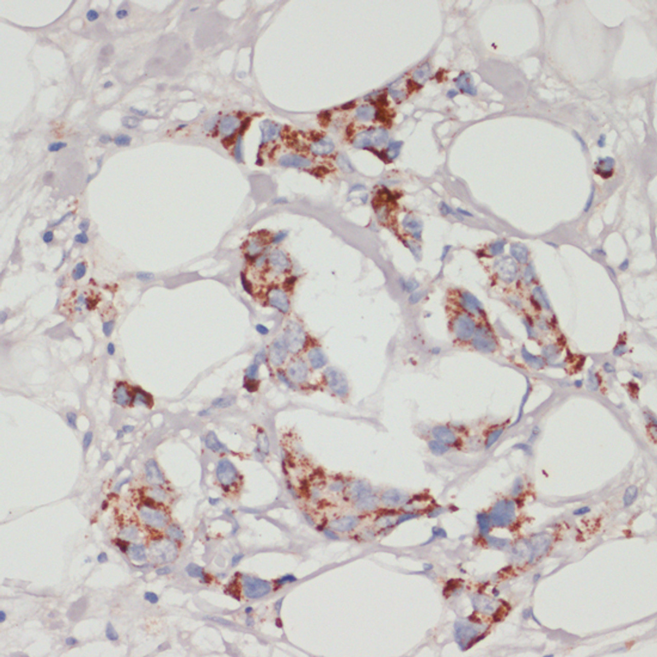 Immunohistochemistry of paraffin-embedded human mammary cancer using ACSL3 antibody (14-096) at dilution of 1:100 (40x lens) .