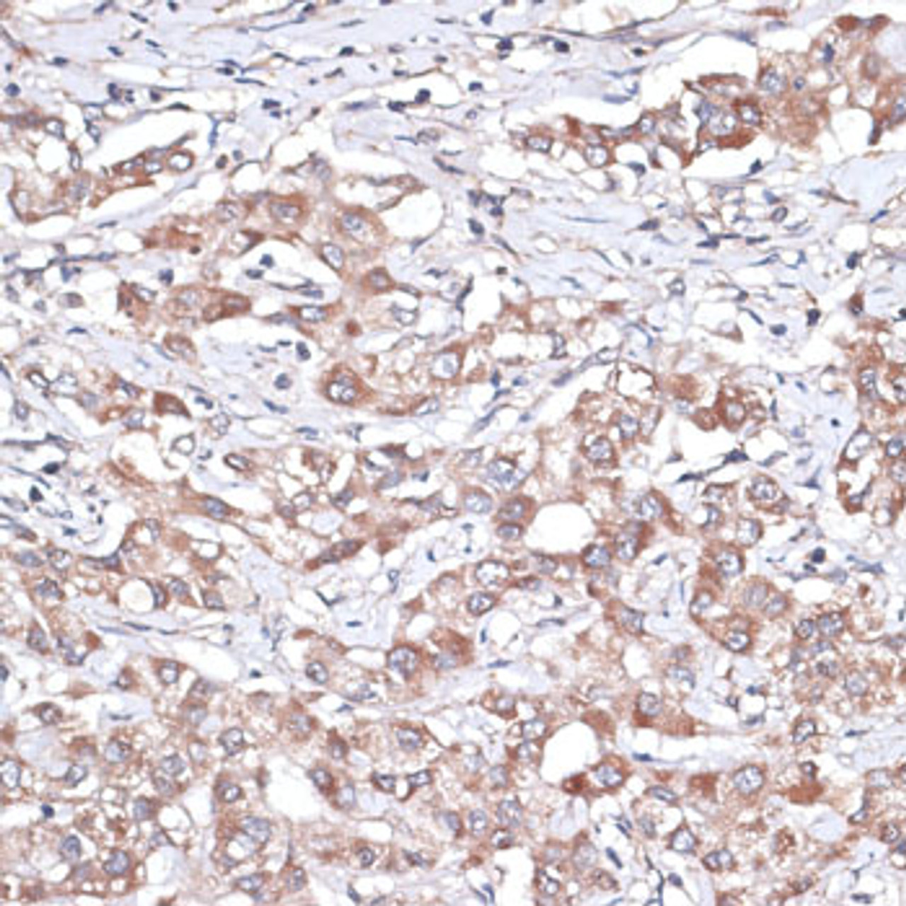 Immunohistochemistry of paraffin-embedded human liver cancer using TGFBR2 antibody (14-143) at dilution of 1:100 (40x lens) .