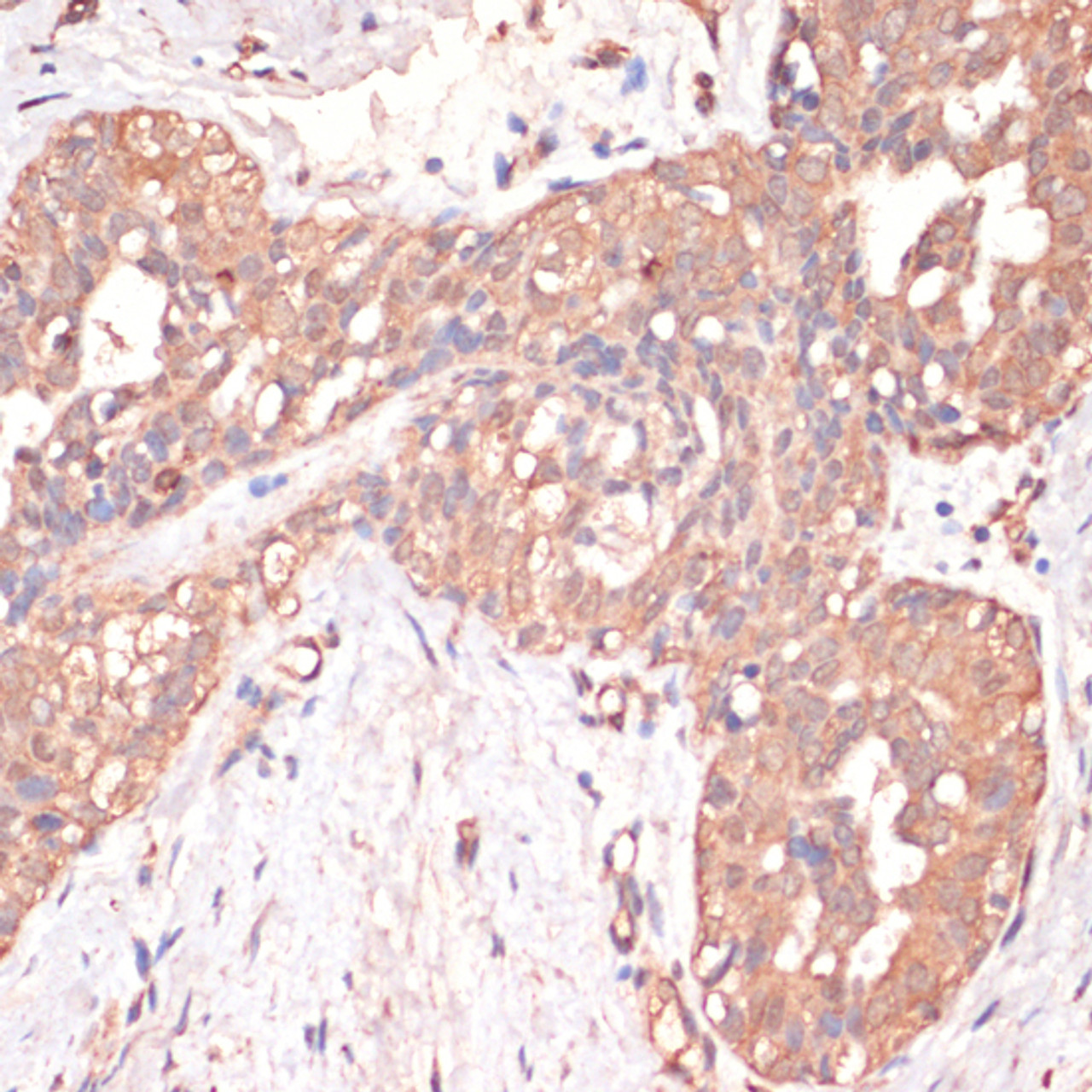 Immunohistochemistry of paraffin-embedded human mammary cancer using Caspase 3 antibody (14-207) at dilution of 1:200 (40x lens) .