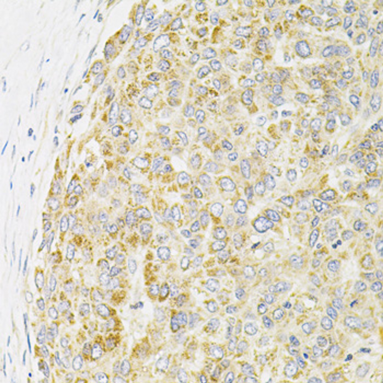 Immunohistochemistry of paraffin-embedded human liver cancer using PPP1CA antibody (14-440) at dilution of 1:100 (40x lens) .