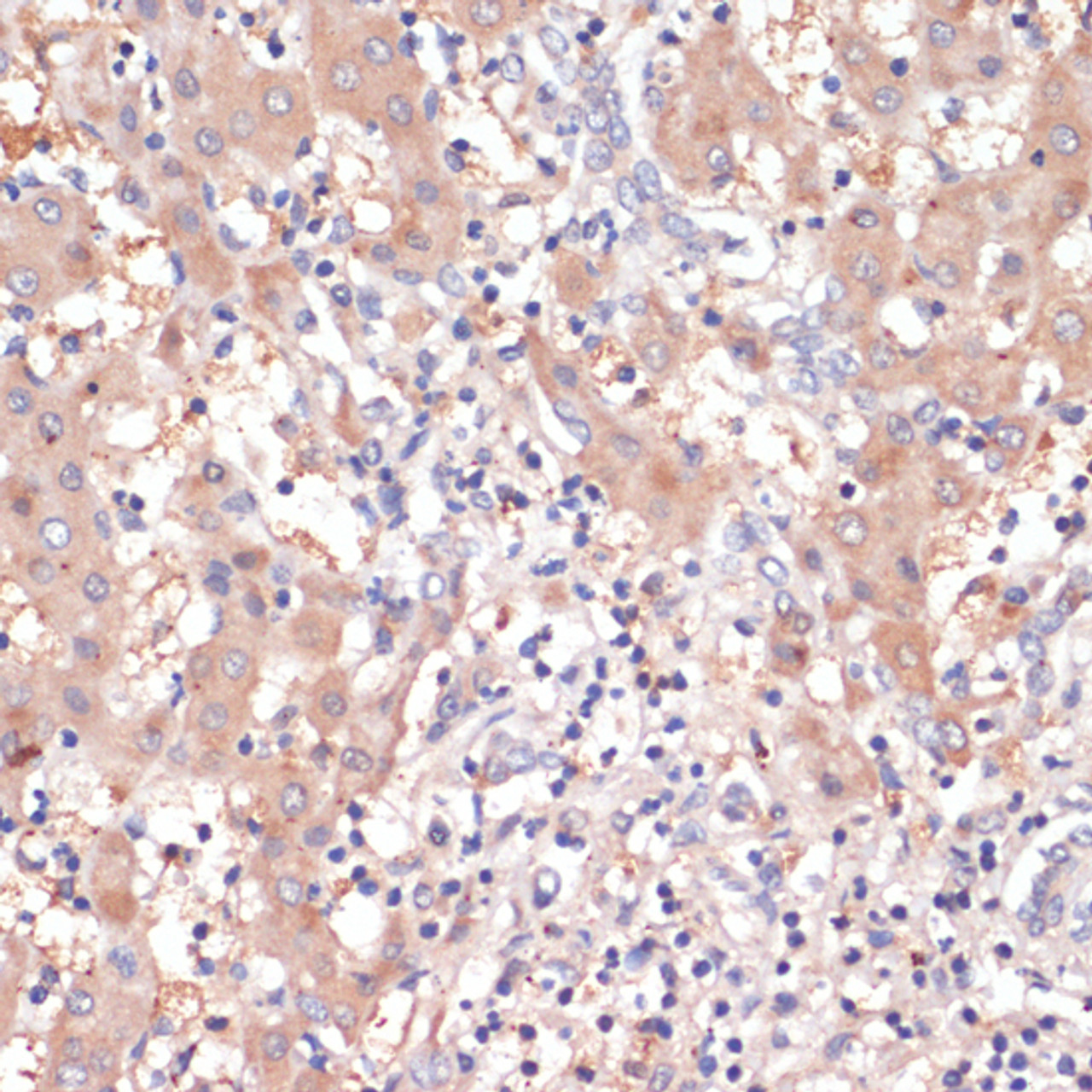 Immunohistochemistry of paraffin-embedded human liver cancer using Cox2 antibody (14-486) at dilution of 1:200 (40x lens) .