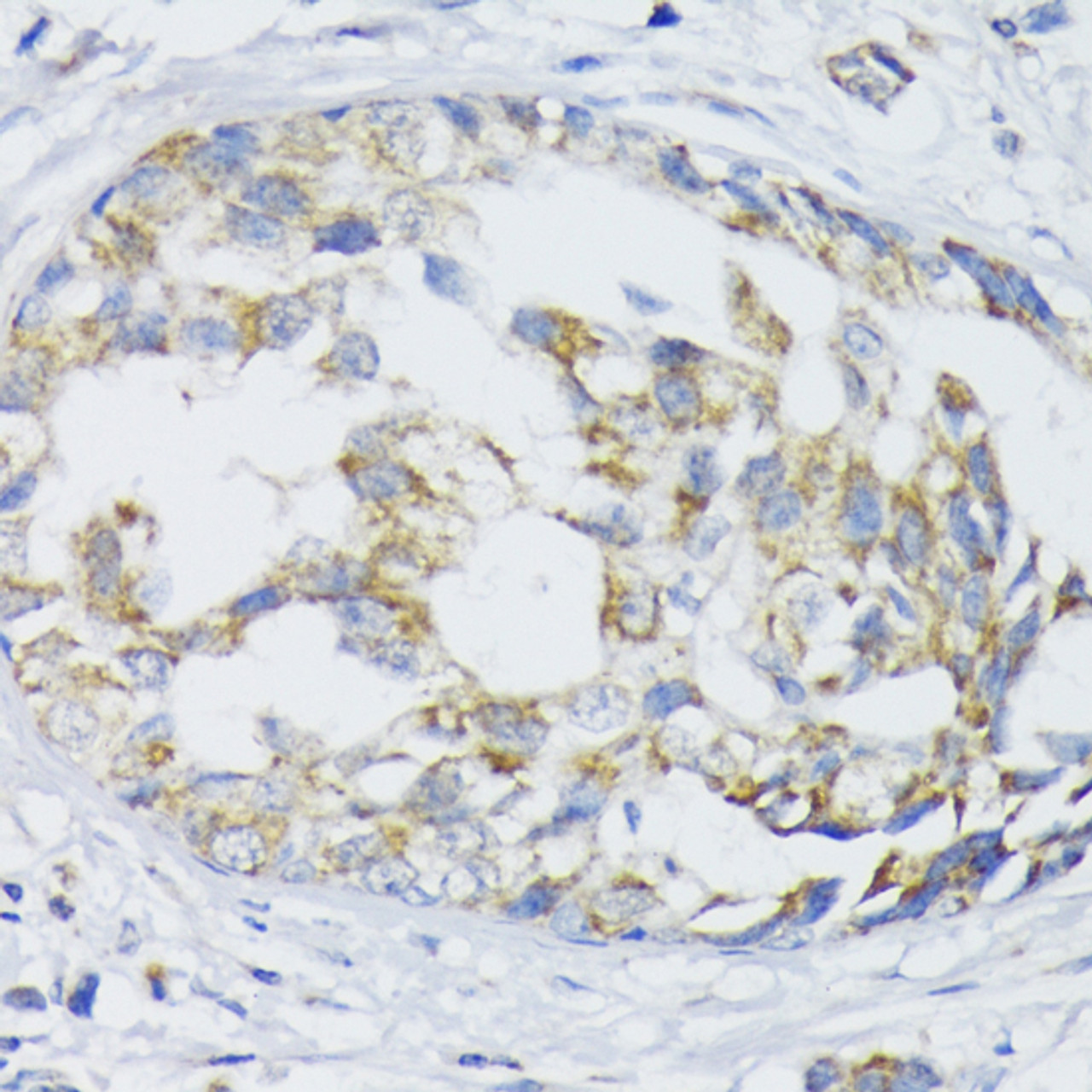 Immunohistochemistry of paraffin-embedded human mammary cancer using SLC30A1 antibody (14-488) at dilution of 1:100 (40x lens) .