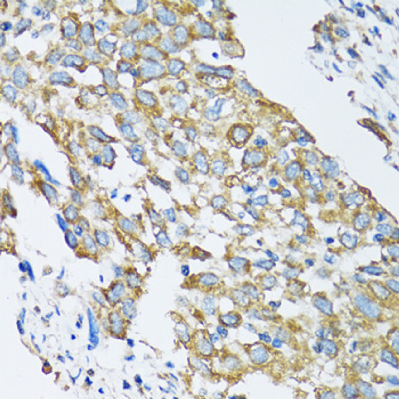 Immunohistochemistry of paraffin-embedded human lung cancer using SLC25A13 antibody (14-506) at dilution of 1:100 (40x lens) .