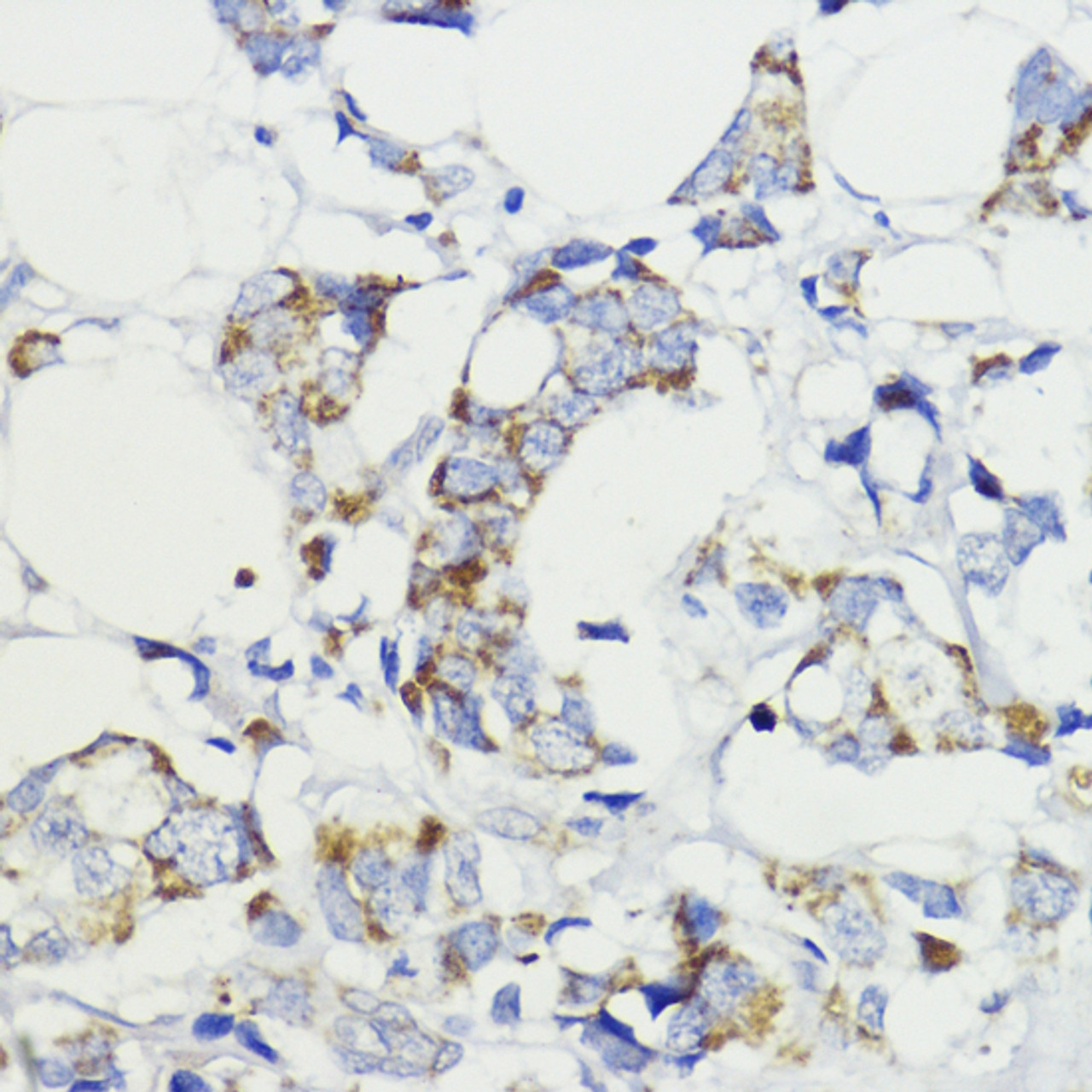 Immunohistochemistry of paraffin-embedded human mammary cancer using VEGFB antibody (14-581) at dilution of 1:200 (40x lens) .