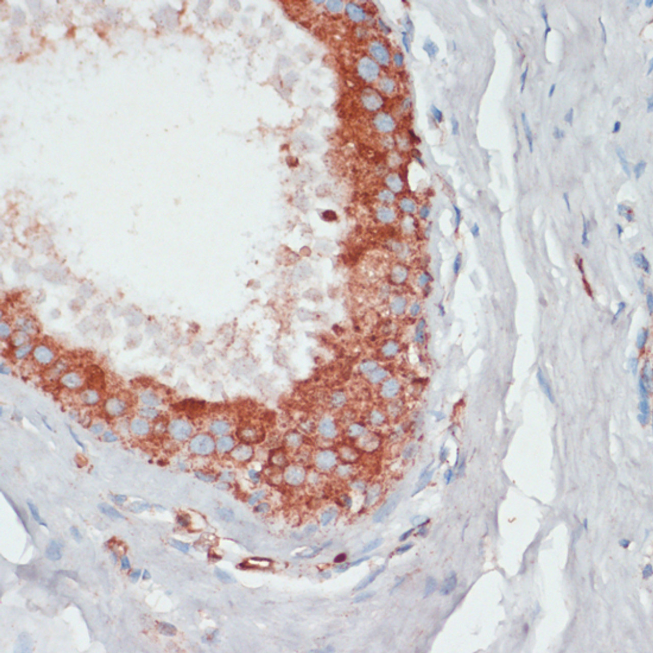 Immunohistochemistry of paraffin-embedded human mammary cancer using PGK2 antibody (14-721) at dilution of 1:100 (40x lens) .