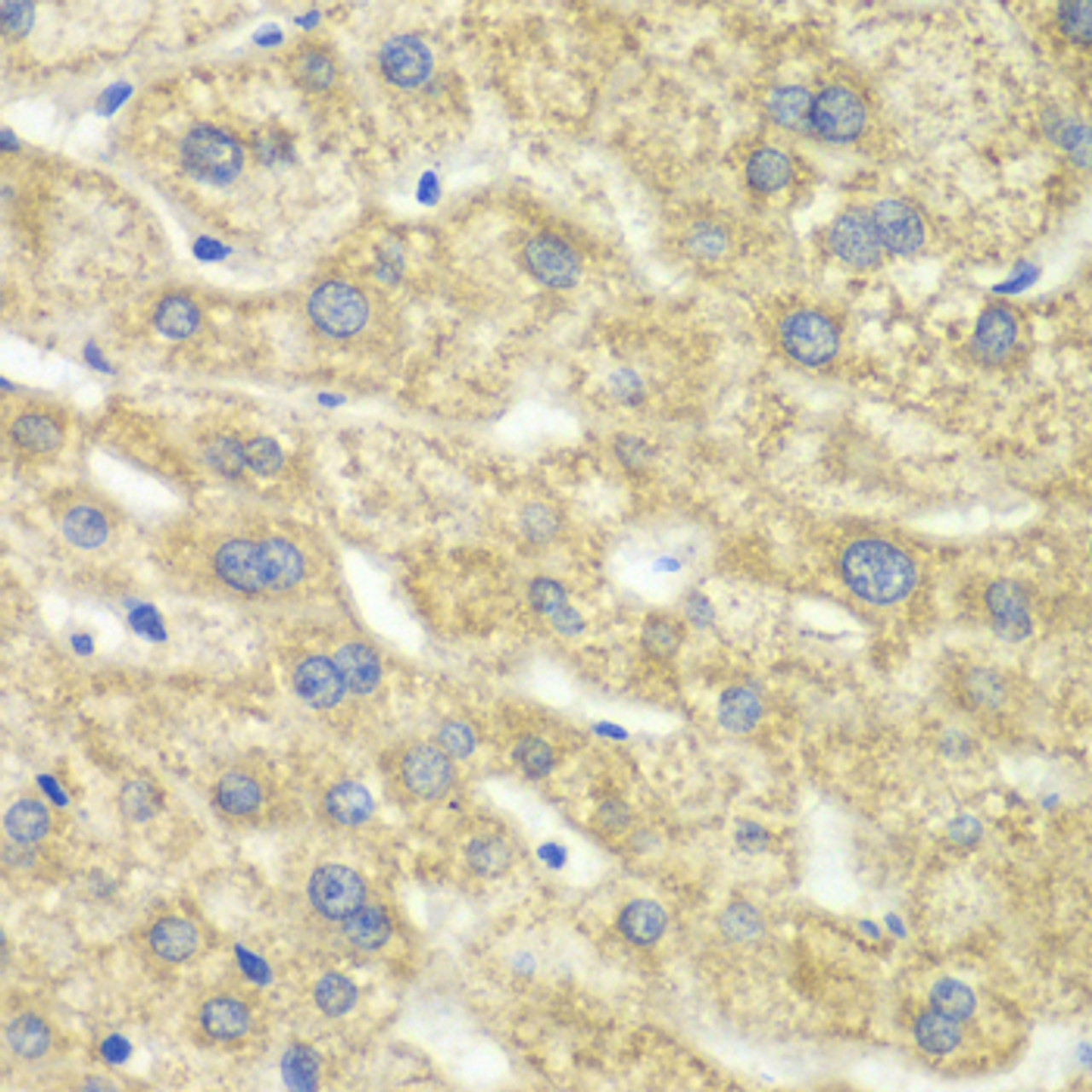 Immunohistochemistry of paraffin-embedded human liver damage using DLD antibody (14-897) at dilution of 1:100 (40x lens) .