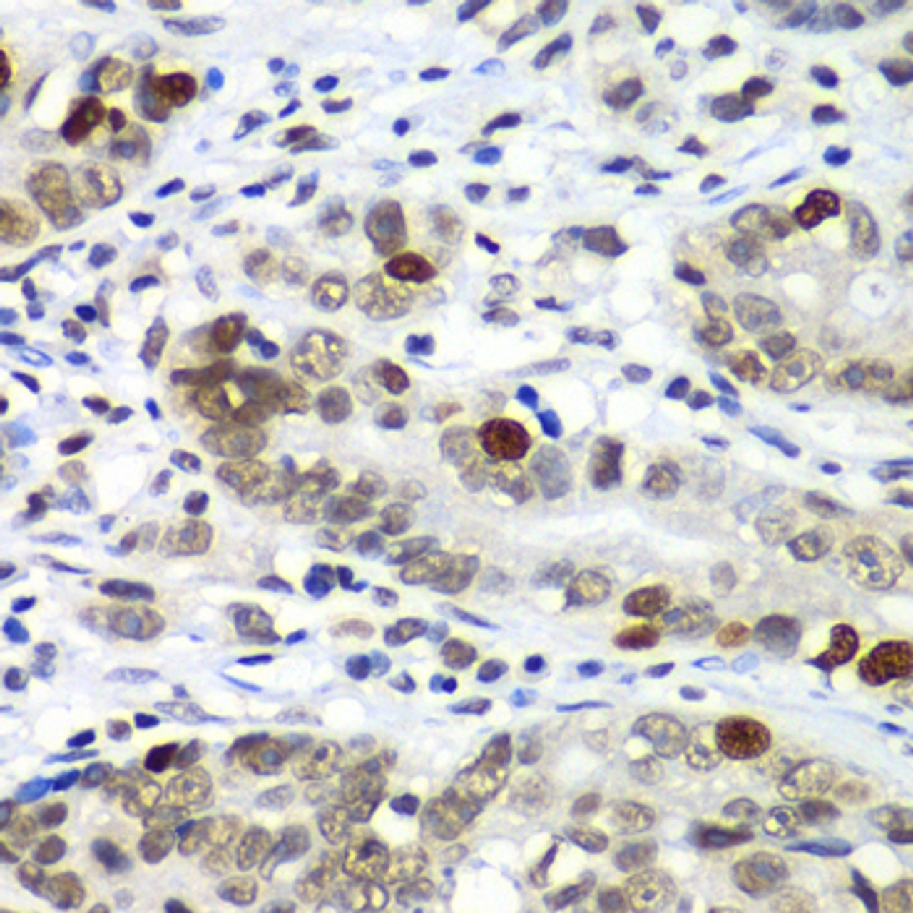 Immunohistochemistry of paraffin-embedded human gastric cancer using DR1 antibody (14-899) at dilution of 1:100 (40x lens) .