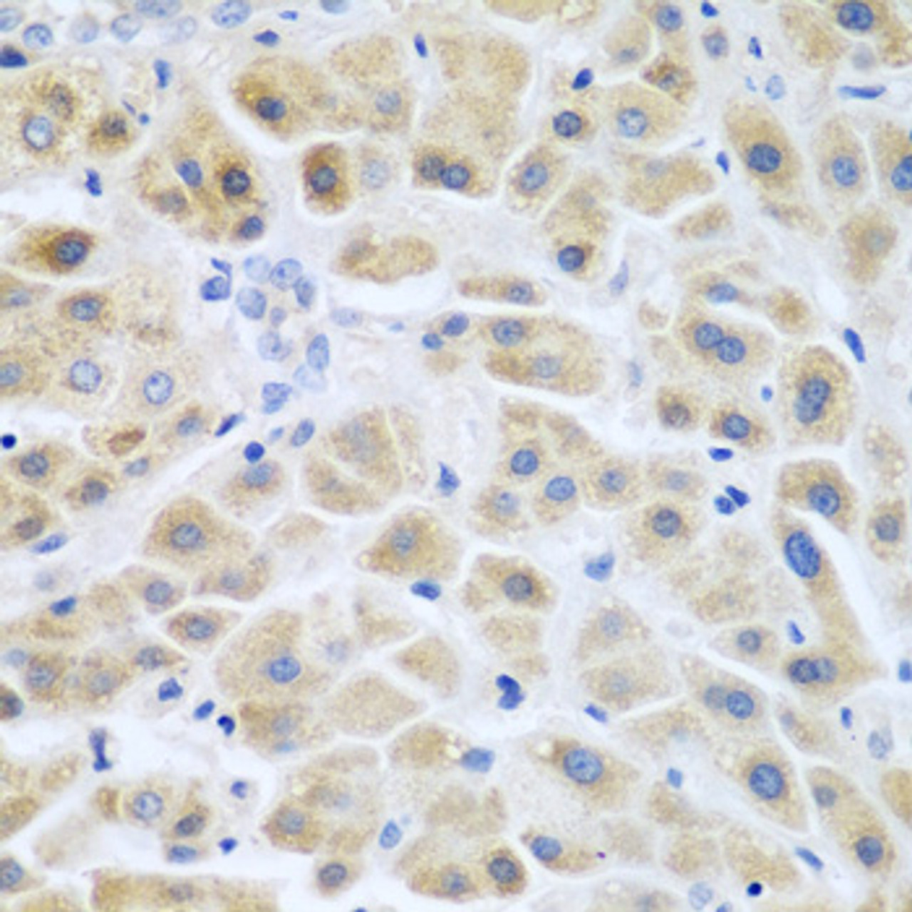 Immunohistochemistry of paraffin-embedded human liver cancer using ACCS antibody (14-992) at dilution of 1:200 (40x lens) .